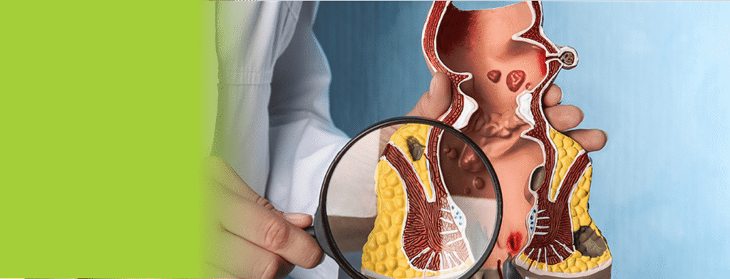 Permanent Relief from Piles with Advanced Surgery