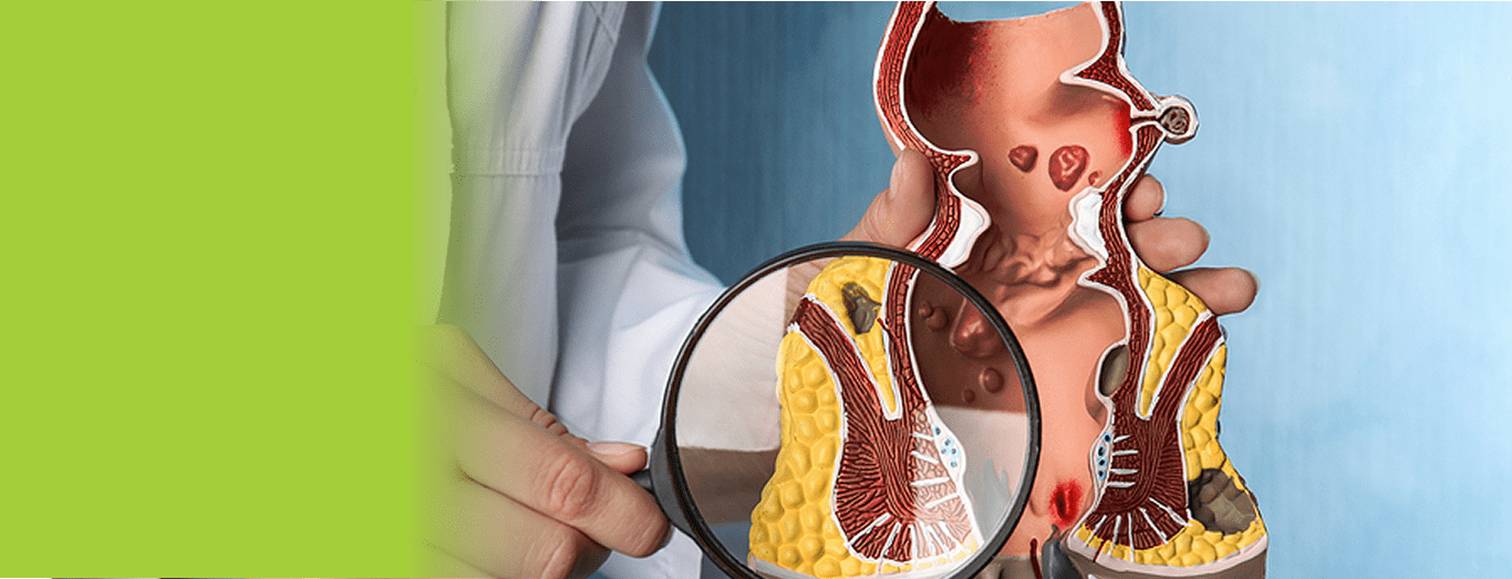 Permanent Relief from Piles with Advanced Surgery