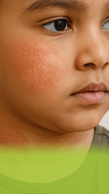 Heat Rash and Skin Problems in Kids During Summer