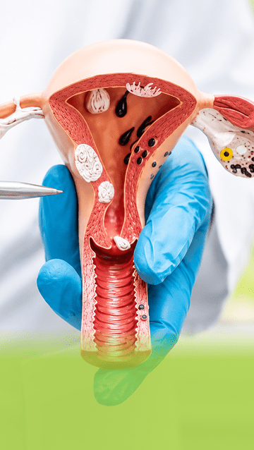 Cervical Cerclage