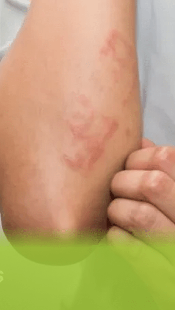 Red Spots on Skin: Causes, Symptoms, Treatment and Prevention