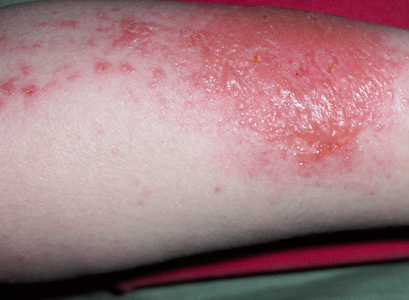 Red Spots on Skin: Causes, Symptoms, Treatment and Prevention