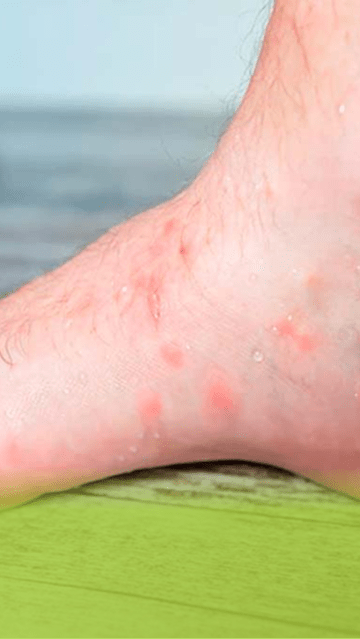 Foot Fungal Infections in Monsoon: Causes, Symptoms, Treatment & Prevention