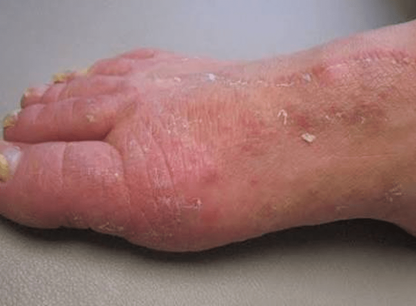 Foot Fungal Infections in Monsoon: Causes and Home Remedies
